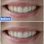 Project: Teeth Whitening Reveal & A Giveaway!
