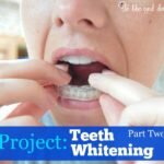 Project: Teeth Whitening Part Two